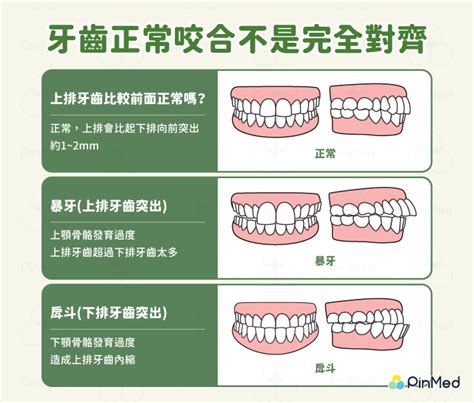 上排牙齒突出正常嗎 外格是什麼